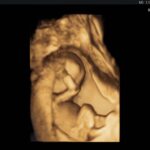 Capucine Anav Instagram – A ce moment précis j’étais enceinte de 5 mois et j’étais à j-2 de vous l’annoncer 😍😍 … 

Ma grossesse était incroyable et j’étais frustrée de devoir vous le cacher pendant 5 mois, mais j’étais obligée pour protéger ma grossesse ! A l’époque j’avais mis cette photo en story en coupant mon ventre … maintenant je la poste entièrement 😍😍😍🫶🏼🫶🏼🫶🏼