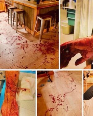Chelsea Peretti Instagram - WARNING!!!‼️ BEAR ATTACK AFTERMATH IMAGE SECOND SLIDE ‼️LETS JUST SAY DONT GET BIT BY A BEAR @clennertzmusic thank you for sharing your tale! 💩💩❤️ @callchelseaperetti #bear #bearattack #bearattacks #bearattacksurvivor #naturelovers