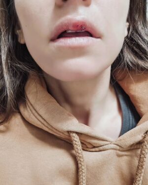 Dana Rogoz Instagram - 134/366 Un alt fel de INAINTE/DUPA. Cea de a doua imagine este de acum, dupa ce în aceasta dimineata am fost cusuta la spital, în zona buzei. Un incident stupid.. am dat practic "buza in cap" cu Lia. Iar capul Liei e foarte rezistent, ea nu a avut nimic. Eu în schimb am avut nevoie de 4 ate care sa imi stranga buza la loc. Problema mea cea mai mare ca e în seara aceasta plec la Baia Mare, pentru ca mâine e programat spectacolul "Domnisoara Iulia". Asadar, tineti-mi pumnii ca sa pot juca! 🙏
