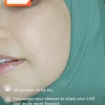 Faezah Elai Instagram - Ni masa live kt tiktok last week.. without any filter..mcm ni lah rupa kulit cheq lani.. klu ushar betoi2 mmg scars still ada Tp sgt pudar.. Been using dermaroller 9 tahun di rumah so ni lah hasil nya.. Klu ampa dh try mcm2 skincare Tp tk menjadi it’s time for treatment.. tk payah stop skincare ampa.. just add on @officialpurestbyfaezahelai on ur daily skincare routine.. . Skrg tgh 50% off all item..half price ja ampa.. lekaih pi beli kt @shopee_my @lazada_my Tiktok Atau whatsapp 0123095202 our skin consultant.. For more info or testimonials boleh visit our IG @officialpurestbyfaezahelai @officialpurestbyfaezahelai @officialpurestbyfaezahelai . #purestbyfe #skincare #skincarejunkie #homemicroneedling #dermaroller #faezahelai