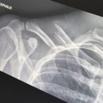 Finneas O’Connell Instagram – Last Friday, I had the pleasure of crashing my electric bike, flying over the handlebars and absolutely demolishing my collarbone as well as sustaining a radial head fracture to my right elbow. The severity of the displacement of my collarbone meant I required surgery which I am now on the other side of and I’m feeling great! I want to give an enormous thank you to Dr. Brian Lee who performed the surgery, Dr. Neal Elattrache and everyone at Kerlan Jobe for their incredible treatment I feel so privileged to have received. I’d also like to thank Jonathan Erb PT for guiding me through the treatment process as well as the ongoing process of physical rehab I now face. I also want to thank my family for their support and love, and most of all Claudia for dropping everything to take care of me the second this happened. She has been an Angel through all of this. I’m told with hard work, I’ll be able to play billie’s forum shows come December which I am so grateful for. As foolish as I felt after the fall, my prevailing emotion is gratitude. You see, I was not wearing a helmet. Lesson forever learned. I feel so lucky to still be here. Take care of yourselves, thank your bodies for all that they do for you. See you all again soon ♥️