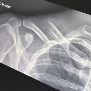Finneas O'Connell Instagram - Last Friday, I had the pleasure of crashing my electric bike, flying over the handlebars and absolutely demolishing my collarbone as well as sustaining a radial head fracture to my right elbow. The severity of the displacement of my collarbone meant I required surgery which I am now on the other side of and I’m feeling great! I want to give an enormous thank you to Dr. Brian Lee who performed the surgery, Dr. Neal Elattrache and everyone at Kerlan Jobe for their incredible treatment I feel so privileged to have received. I’d also like to thank Jonathan Erb PT for guiding me through the treatment process as well as the ongoing process of physical rehab I now face. I also want to thank my family for their support and love, and most of all Claudia for dropping everything to take care of me the second this happened. She has been an Angel through all of this. I’m told with hard work, I’ll be able to play billie’s forum shows come December which I am so grateful for. As foolish as I felt after the fall, my prevailing emotion is gratitude. You see, I was not wearing a helmet. Lesson forever learned. I feel so lucky to still be here. Take care of yourselves, thank your bodies for all that they do for you. See you all again soon ♥️