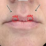 Gabriela Castrovinci Instagram - Valentine’s Day is approaching fast ! Time to prepare those stunning, KISSABLE/DSL lips! Today’s highlight is one of the most challenging cases I’ve faced - lips with a unique “M” shape, making it a true test to achieve that perfect, full look. 💉💋💏 🍆💦 #lips #lipfiller #dsl #explorepage #lipinjections #kisseblelips