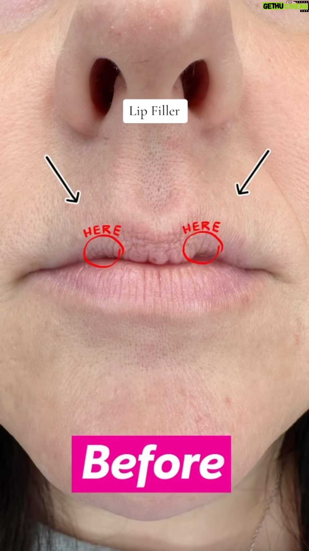 Gabriela Castrovinci Instagram - Valentine’s Day is approaching fast ! Time to prepare those stunning, KISSABLE/DSL lips! Today’s highlight is one of the most challenging cases I’ve faced - lips with a unique “M” shape, making it a true test to achieve that perfect, full look. 💉💋💏 🍆💦 #lips #lipfiller #dsl #explorepage #lipinjections #kisseblelips