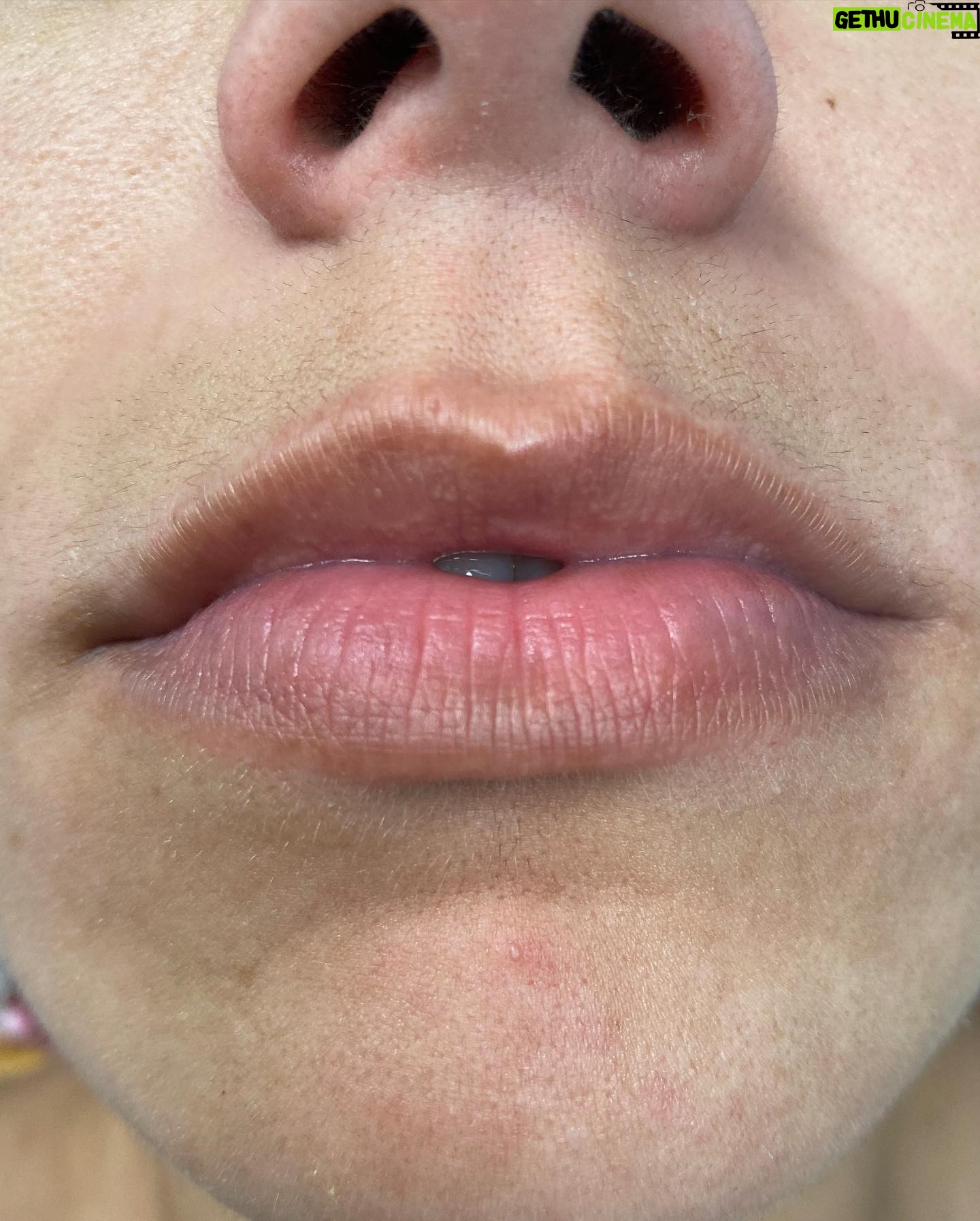 Gabriela Castrovinci - 3 Likes - Selfie with one of my favorite patients @quelbarb2021 💋💉😍 We added another 1.2ml of Lip by @revanesseusa @revanesse. Swipe 👉🏼 to see her before & after.