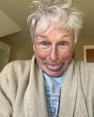 Glenn Close Instagram - I think this is going to be a particularly GOOD day. 
(Ignore the bruises. I had a tiny break in my nose fixed) Feeling as beautiful as ever.