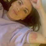 Hayley Atwell Instagram – A little juicy bruising, proudly obtained from doing my own stunts. Arnica cream soon sorted this one out. As a kid, I’d always have bruises on my legs from climbing trees and playing rugby… the price I paid for having outrageous amounts of frantic fun!