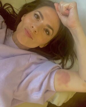 Hayley Atwell Instagram - A little juicy bruising, proudly obtained from doing my own stunts. Arnica cream soon sorted this one out. As a kid, I’d always have bruises on my legs from climbing trees and playing rugby… the price I paid for having outrageous amounts of frantic fun!