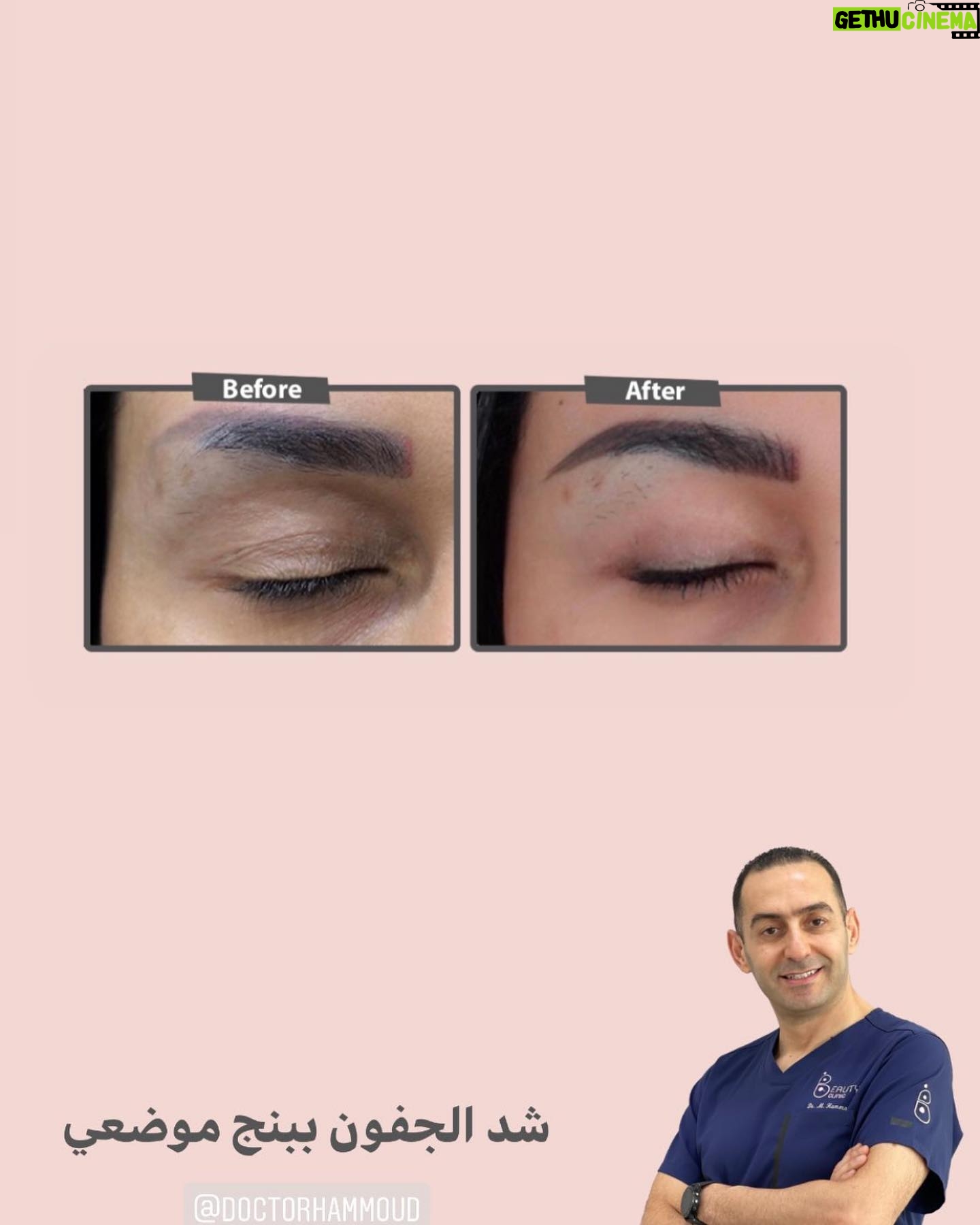 Huda Husain Instagram - دكتور محمد حمود وعملية جفوني القادمه بتكون معاه في عيادة بيوتي كلينك @beautyclinick