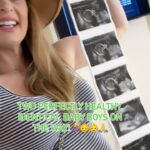Jamie Otis Instagram – I went from being told if I wanted another baby I’d need IVF to conceiving healthy identical twins naturally🤯 Never, ever believe everything you hear😉🙏

I’ve been diagnosed with a blocked fallopian tube, MTHFR, low-normal AMH, hypothyroidism, secondary infertility, and I’ve been told I’m “Geriatric” for pregnancy👵🏻😅

We were gearing up for IVF, but I just couldn’t believe I needed it since I already have two healthy babies we conceived naturally🤷🏼‍♀️

I decided to change my lifestyle. I began going to the gym. I cut out all alcohol and coffee/energy drinks. I cut waaay back on gluten, dairy, and processed sugars. I began taking any  and all supplements that I heard helped others get pregnant and keep their pregnancy! 

After MONTHS of this and still no luck, I felt kinda defeated. A friend came over and said “give God all the glory”

I didn’t even know how to give God all the glory but that night I prayed and said I would. I read a book called supernatural childbirth and it inspired me to try to have total faith in God & stop trying so hard myself.🤷🏼‍♀️ 

My next ovulation cycle we were on a cruise. I decided to stop peeing on all the ovulation sticks, stop taking my gazillion supplements, stop timing our love life so perfectly —and I prayed the egg would split if I got pregnant.🙏 my hubby wanted to stop at 3 and I’ve always wanted identical twins!😜🥰

A few weeks later I found out I got pregnant naturally … a couple weeks after that I found out there are TWO in me! And a couple weeks after that I found out they are identical 🤯🙏❤️

All of this to say, if you’ve been trying to conceive and it hasn’t been working out for you – I’m so sorry!😞 I know it hurts!😢 The most annoying thing to hear when you’re trying to get pregnant and it hasn’t been working is “just stop trying and you’ll get pregnant”…so I won’t say that!

But something happened when I intentionally let go and trusted God❤️ If it worked for me, I believe it can work for you too!🙏

If you’ve read this far I want you to know I am sending you SO MUCH LOVE.💕 Hang in there mama, your rainbow is coming 🌈