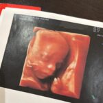 Jesta Hillmann Instagram - T2 morphologie et je dois vous annoncer QUE TOUT VA BIEN 🥹🤍 Il n’y a plus d’hématomes et bébé va super bien, il grandit parfaitement et se développe à merveille 🙏🏼