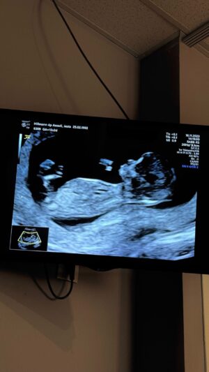 Jesta Hillmann Instagram - J’étais tellement pressé de savoir si j’étais enceinte que j’avais fais des tests bien trop tôt qui m’indiquaient tous négatif. J’avais dis à Benoît que ça n’avait pas marché cette fois ci dès le premier essai.. 2 jours plus tard, un soir je décide de faire un dernier test car mon corps me disait le contraire.. et paf ! Même si je suis tombé enceinte directement après l’arrêt de la contraception c’était finalement une surprise de voir cette très très fine et légère deuxième barres qu’on espérait tant 🥹🙏🏼 C’était voulu et très rapide mais du coup l’émotion fut intense 🤍