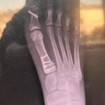 Jodie Sweetin Instagram - Woo hoo! The cast is off and I’m toddling around like a 2 year old. Literally… baby steps. (Scroll through to see my bionic foot)