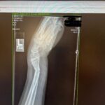 Julie Bowen Instagram - It’s not a vacation without a trip to the ER for a broken wrist… Both bones broken, but John is on the mend and his brothers were total champs.