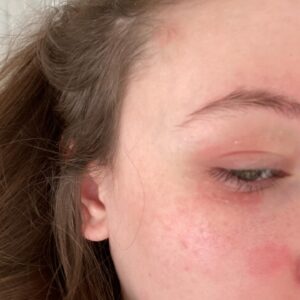 Katelyn Nacon Instagram - Recently found out I have psoriasis ➡️ Who else?🙋‍♀️