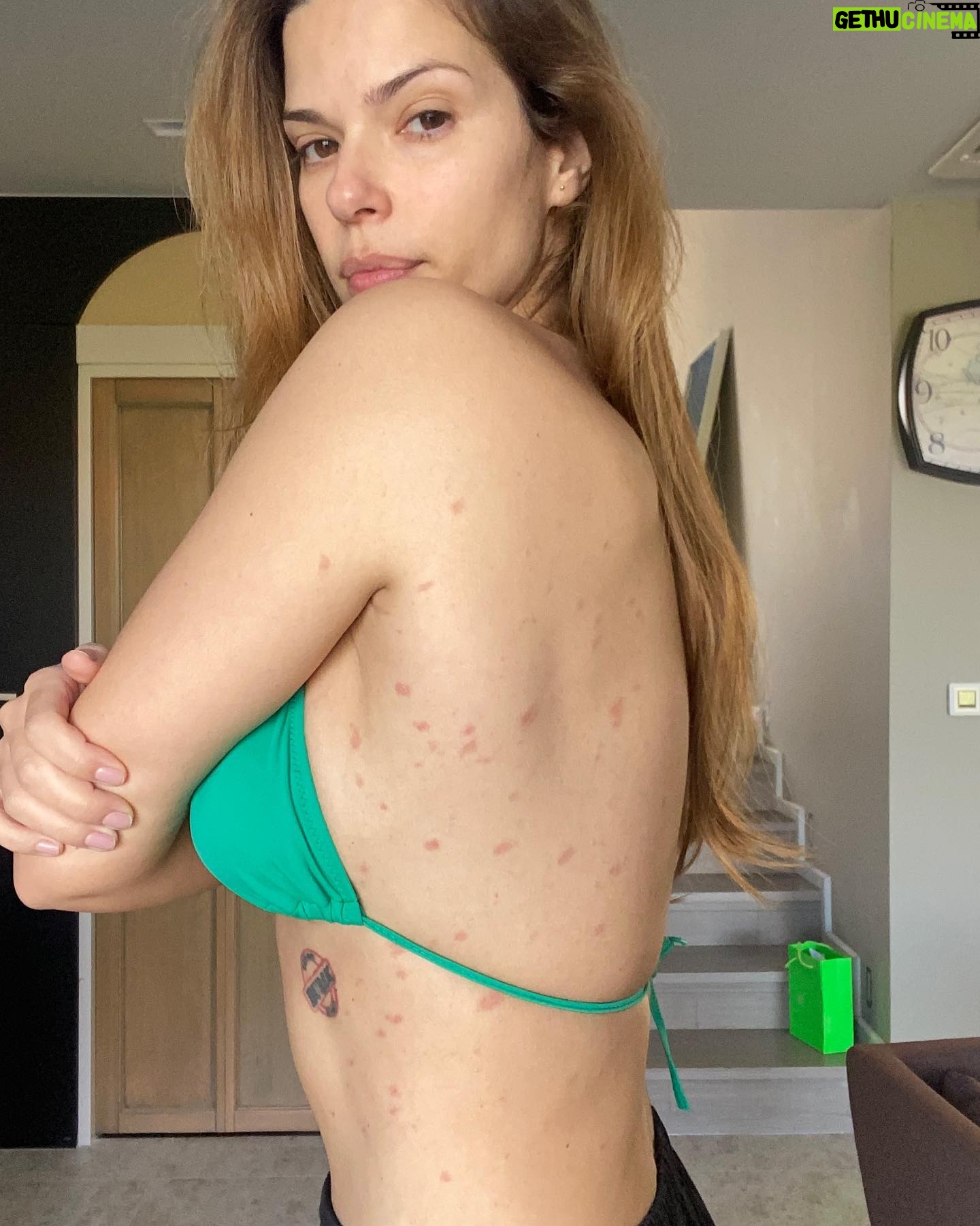 Larissa Gacemer Instagram - Güzel insanlar, depremden 1 hafta sonra bir sabah kalktım ve elimi sırtıma geçince bir kaç nokta hissetim alerji sandım ama kaşıntı yoktu, çok önemsemedim ama ertesi gün kırmızı olmayı başladı ve bacağımda büyü bir kırmızı leke gördük Burak beni hastane götürmeye karar verdi 😅.. Doktor direkt “Pityriasis Rosea” Gül Hastalığı olarak teşhis koydu, bu stresten dolayı oluyor. Kaşınmıyor, sadece bazen sanki batıyor gibi terleyince 😵💫 O yüzden spor da biraz ara verdim 😅 bu bulaşan bir hastalık değil. Çocuklarda çok oluyormuş duyunca üzüldüm onlar için 😔Sizinle paylaşmak istedim çünkü 2 ay oldu ve geçmeye başladı, iyileşiyorum🥳 ! Çok kişi bunu yaşıyor ve utanıyor, utanacak hiçbir şey yok ! Bu da geçer. ♥️🫶🏻🤩 Not. Son foto bugün🥰