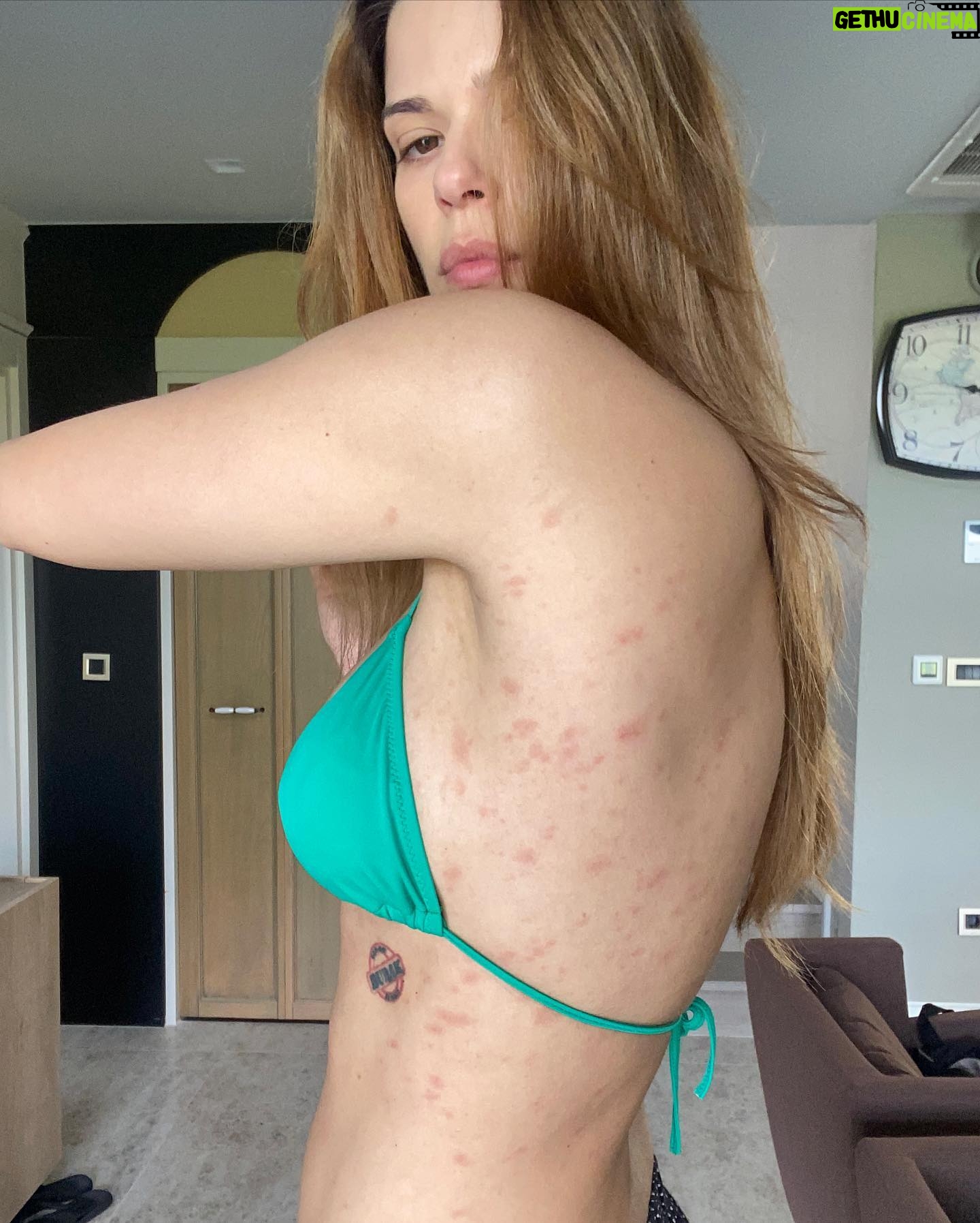 Larissa Gacemer Instagram - Güzel insanlar, depremden 1 hafta sonra bir sabah kalktım ve elimi sırtıma geçince bir kaç nokta hissetim alerji sandım ama kaşıntı yoktu, çok önemsemedim ama ertesi gün kırmızı olmayı başladı ve bacağımda büyü bir kırmızı leke gördük Burak beni hastane götürmeye karar verdi 😅.. Doktor direkt “Pityriasis Rosea” Gül Hastalığı olarak teşhis koydu, bu stresten dolayı oluyor. Kaşınmıyor, sadece bazen sanki batıyor gibi terleyince 😵💫 O yüzden spor da biraz ara verdim 😅 bu bulaşan bir hastalık değil. Çocuklarda çok oluyormuş duyunca üzüldüm onlar için 😔Sizinle paylaşmak istedim çünkü 2 ay oldu ve geçmeye başladı, iyileşiyorum🥳 ! Çok kişi bunu yaşıyor ve utanıyor, utanacak hiçbir şey yok ! Bu da geçer. ♥️🫶🏻🤩 Not. Son foto bugün🥰