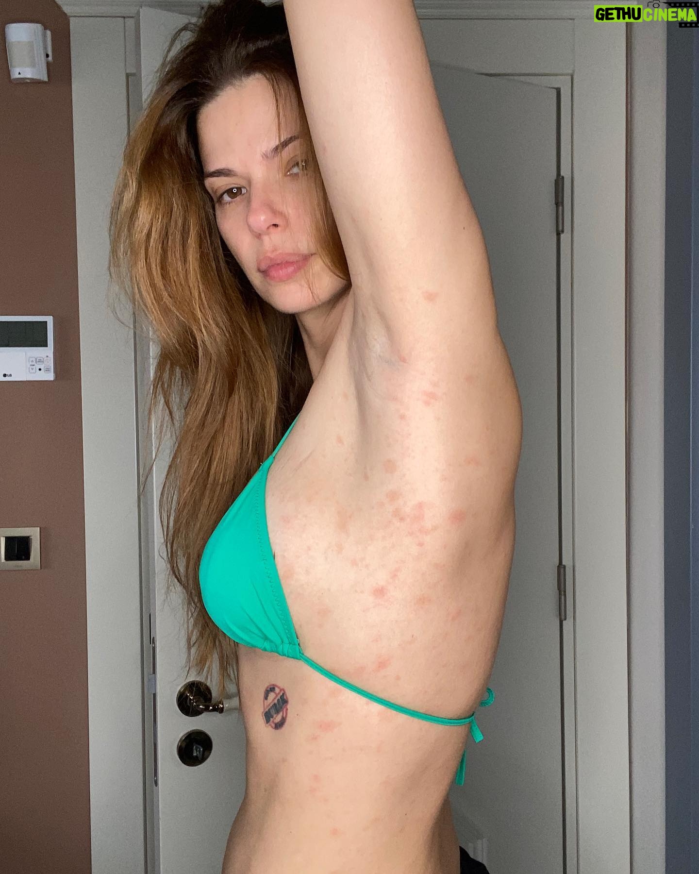 Larissa Gacemer Instagram - Güzel insanlar, depremden 1 hafta sonra bir sabah kalktım ve elimi sırtıma geçince bir kaç nokta hissetim alerji sandım ama kaşıntı yoktu, çok önemsemedim ama ertesi gün kırmızı olmayı başladı ve bacağımda büyü bir kırmızı leke gördük Burak beni hastane götürmeye karar verdi 😅.. Doktor direkt “Pityriasis Rosea” Gül Hastalığı olarak teşhis koydu, bu stresten dolayı oluyor. Kaşınmıyor, sadece bazen sanki batıyor gibi terleyince 😵💫 O yüzden spor da biraz ara verdim 😅 bu bulaşan bir hastalık değil. Çocuklarda çok oluyormuş duyunca üzüldüm onlar için 😔Sizinle paylaşmak istedim çünkü 2 ay oldu ve geçmeye başladı, iyileşiyorum🥳 ! Çok kişi bunu yaşıyor ve utanıyor, utanacak hiçbir şey yok ! Bu da geçer. ♥️🫶🏻🤩 Not. Son foto bugün🥰