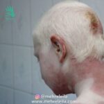 Leila Bolukat Instagram - سلام به شما عزیزانم ببخشید که باید این ویدیو رو تا اخر ببینید لطفا 🙏😢🙏 از همراهیتون بسیار ممنونیم تشکر ویژه از وحید آقا پور نازنین و احسان کرمی عزیز و آقای نعلبران همینطور دکتر سعید دادگر که در جمع آوری هزینه درمان این کودک تا به الان کمک کردند و همینطور خانم ترسول عزیز از مشهد مقدس ،خدا حفظتون کنه 🙏 این پسر قشنک ما که مبتلا به بیماری زال هستش زمان بازی ، دچار ۷۶ درصد سوختگی شد و بسیار شرایط بدی داشت، جراحیهای اولیه انجام شد ولی در ادامه باز هم جراحیهای سختی خواهد داشت ،برای اطلاعات بیشتر به پیج مهر لیلا سری بزنید و در اونجا روند درمان این بچه نازنین ما رو پیگیر باشید 🙏 @mehreleila برای کمک به تامین هزینه های درمان فرزند دلبندمان .نیازمند همیاری شما مهربانان هستیم. خواهشمندیم در این مسیر سخت و طولانی کنار ما باشید. شماره کارت بانک شهر: 5047_0610_9002_1805 کد دستوری : *780*870# #مهرلیلا #لیلا_بلوکات #خیریه_مهرلیلا #موسسه_خیریه_مهرلیلا با سپاس از آقای سعید خدارضایی برای ساخت ویدیو 🌹 #لیلا_بلوکات #خیریه_مهر_لیلا #دست_منو_تو_قصري_ميسازد_از_جنس_امید