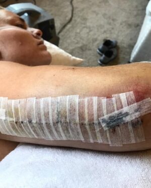 Lindsey Vonn Instagram - I’ve been bruised and broken but I’ve always come out the other side a better person. No matter how many times I fell, I always got back up. I didn’t do it alone though. I am so thankful to have had the support of friends, family and you guys, my fans. Knowing I had people supporting me helped me in my darkest hours. Every day I tried to put one foot in front of the other until it eventually got me back to where I wanted to go… which was usually the top of the mountain 🏔️ 😍 We are all on our own paths, but if you’re injured or going through a hard time, believe in yourself and know that you will come out of it a better and stronger person. You got this 💪🏻