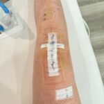 Lindsey Vonn Instagram – After a lot of thought, research and talking to many many doctors, I made the decision to get a knee replacement. I have severe tri-compartment degeneration but the main compartment that has been painful is the lateral compartment, or the outside of my knee. My doctor for many of my surgeries, Dr Hackett, and I did a preparation surgery last July to try to slow down the need for the replacement but also preparing other parts of my knee for the inevitable. But I got to the point where it was too much and my knee could not handle doing the things I love to do. 

So Dr. Roche did a Mako Robot assisted lateral unicompartmental replacement. In other words, they cut off part of my bone and replaced it with titanium pieces. *in pic 2

Dr Roche and his team did an incredible job and I’m recovering well. I hope this helps me lead the active life I’ve always wanted. 

Appreciate all of the well wishes🙏🏻 Means a lot to me. But don’t worry, this is just another bump in the road in my journey through life and you know I’ll be back up and running asap 💪🏻 can’t hold me down for long!

🙏🏻❤️