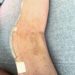 Lindsey Vonn Instagram – After a lot of thought, research and talking to many many doctors, I made the decision to get a knee replacement. I have severe tri-compartment degeneration but the main compartment that has been painful is the lateral compartment, or the outside of my knee. My doctor for many of my surgeries, Dr Hackett, and I did a preparation surgery last July to try to slow down the need for the replacement but also preparing other parts of my knee for the inevitable. But I got to the point where it was too much and my knee could not handle doing the things I love to do. 

So Dr. Roche did a Mako Robot assisted lateral unicompartmental replacement. In other words, they cut off part of my bone and replaced it with titanium pieces. *in pic 2

Dr Roche and his team did an incredible job and I’m recovering well. I hope this helps me lead the active life I’ve always wanted. 

Appreciate all of the well wishes🙏🏻 Means a lot to me. But don’t worry, this is just another bump in the road in my journey through life and you know I’ll be back up and running asap 💪🏻 can’t hold me down for long!

🙏🏻❤️