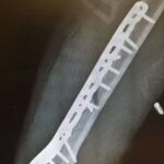 Lindsey Vonn Instagram – I’ve been bruised and broken but I’ve always come out the other side a better person. No matter how many times I fell, I always got back up. I didn’t do it alone though. I am so thankful to have had the support of friends, family and you guys, my fans. Knowing I had people supporting me helped me in my darkest hours. Every day I tried to put one foot in front of the other until it eventually got me back to where I wanted to go… which was usually the top of the mountain 🏔️ 😍 We are all on our own paths, but if you’re injured or going through a hard time, believe in yourself and know that you will come out of it a better and stronger person. You got this 💪🏻