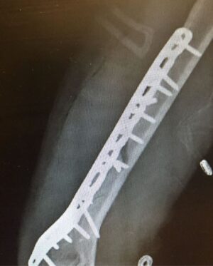 Lindsey Vonn Instagram - I’ve been bruised and broken but I’ve always come out the other side a better person. No matter how many times I fell, I always got back up. I didn’t do it alone though. I am so thankful to have had the support of friends, family and you guys, my fans. Knowing I had people supporting me helped me in my darkest hours. Every day I tried to put one foot in front of the other until it eventually got me back to where I wanted to go… which was usually the top of the mountain 🏔️ 😍 We are all on our own paths, but if you’re injured or going through a hard time, believe in yourself and know that you will come out of it a better and stronger person. You got this 💪🏻