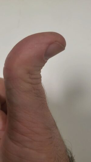 Michael Stevens Instagram - Hitchhiker's Thumb

#anatomy #thumb #hyperextensibility #distal #phalanges #fingers #bones #hand #pedropascal #adele #jessicalaba #michaelstevens #etymology #bend #backwards