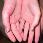 Sara Waisglass Instagram - if you’re going on vacation soon, you simply must try getting stung by a sea urchin! Having your partner pull the poisonous needles out of your fingers in the hotel lobby is so much fun and a great bonding experience! that was all sarcasm please don’t do that. hehe! goodbye Hawaii!