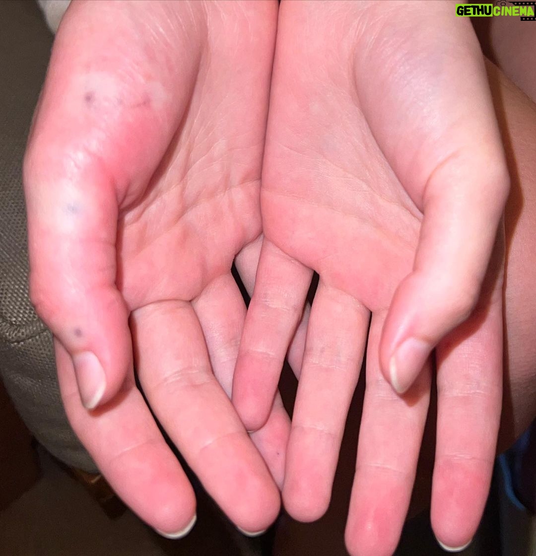 Sara Waisglass Instagram - if you’re going on vacation soon, you simply must try getting stung by a sea urchin! Having your partner pull the poisonous needles out of your fingers in the hotel lobby is so much fun and a great bonding experience! that was all sarcasm please don’t do that. hehe! goodbye Hawaii!