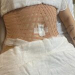 Solange Gomes Instagram - Parte 1 . Etapas. Abdominoplastia com lipo @stephaniegomees Cirurgião plástico @davidsimiss Em breve, resultado pra vocês. #cirurgiaplastica