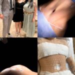 Solange Gomes Instagram – Ainda sem acreditar que essa no vídeo sou eu! Resultado imediato da Lipo   Abdominoplastia e enxertia glútea pela as mãos do Dr. @davidsimiss . Agora, a recuperação me aguarda tendo a minha mãe @gomessolange como a minha enfermeira pessoal ❤️ 

Obs: O resultado final leva algum tempo, mas já deu para ver a minha grande conquista✨