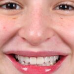 Sophia Valverde Instagram - o nosso toque de arte para a @sophiavalverde . Ela tinha os dentes curtos e pouco expressivos, e ela buscava um sorriso que fosse mais atraente, com mais poder, mas que fosse leve e absolutamente natural. Feito. Cerâmica sobre refratário, a natureza em camadas, pelas mãos do artista do ateliê @designrobsonrichardt .