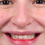 Sophia Valverde Instagram - o nosso toque de arte para a @sophiavalverde . Ela tinha os dentes curtos e pouco expressivos, e ela buscava um sorriso que fosse mais atraente, com mais poder, mas que fosse leve e absolutamente natural. Feito. Cerâmica sobre refratário, a natureza em camadas, pelas mãos do artista do ateliê @designrobsonrichardt .
