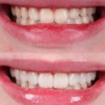 Sophia Valverde Instagram - o nosso toque de arte para a @sophiavalverde . Ela tinha os dentes curtos e pouco expressivos, e ela buscava um sorriso que fosse mais atraente, com mais poder, mas que fosse leve e absolutamente natural. Feito. Cerâmica sobre refratário, a natureza em camadas, pelas mãos do artista do ateliê @designrobsonrichardt .