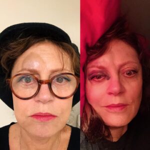 Susan Sarandon Instagram - A little slip = concussion, fractured nose, banged up knee. So, looks like I won’t be able to meet the folks in New Hampshire with Senator Sanders tomorrow. I’m really sorry I’ll miss that opportunity but here’s what I’d hoped to say:

This is an emergency. Ask the scientists, the farmers, the creatures in the sea. Ask all those who have lost their homes from hurricanes, flood and fire, ask the endless stream of climate refugees, and the people of Flint, San Juan, and Standing Rock. This is a emergency. Ask the mothers who have lost their children to the opioid epidemic or because of the price of insulin. Ask the mothers who have lost their kids to gun violence in schools, in churches, in their bedrooms. This is an emergency. Ask those separated from their families at the border, or those separated from their loved ones by an unjust, racist, for-profit prison system. This is an emergency when our young people have no hope for education, for dream-making, because of insurmountable student debt. When teachers are forced to have additional jobs and when 40 hours of honest labor can still leave you in poverty. When homophobia, Islamaphobia, transphobia and racism take lives, that is an emergency.

This is not the time for a “pathway” to or “framework” for incremental change. Emergencies require bold, visionary leadership. Senator Sanders believes in us and that together a better world is possible. He has been fighting for social, racial and economic justice his entire life, long before running for President, often before it was acceptable. Now it’s time for us to fight for him.