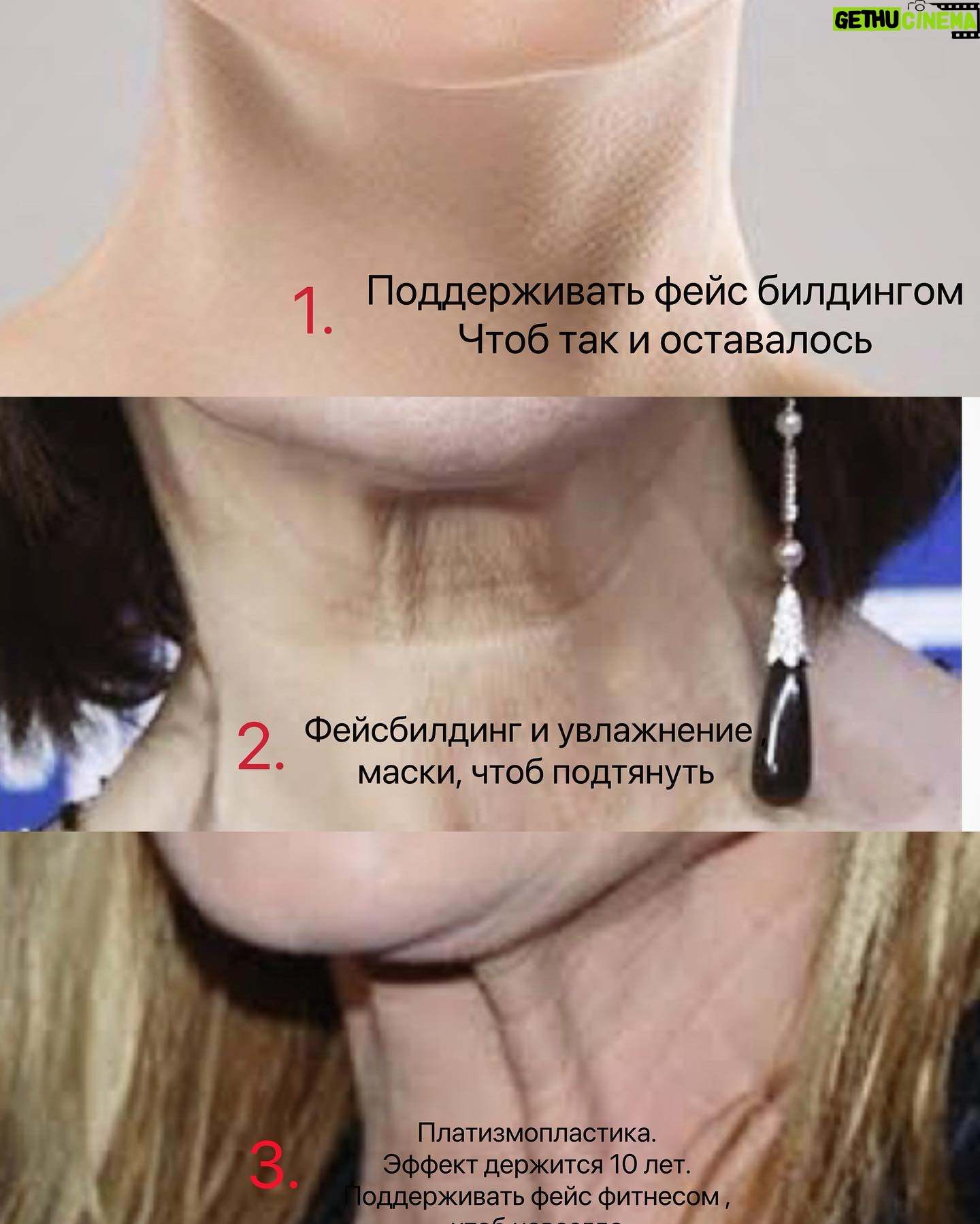 Valeria Lukyanova Instagram - Рубрика - вопросы читателей. «Здравствуйте Валерия , расскажите как омолодить шею если началось обвисание платизмы? Помогут ли какие-то уколы? Чтото можете посоветовать? Спасибо за ваш труд, вдохновляет ваша страница!» Приветствую спасибо за теплые слова дорогая. Увы , уколы для омоложения шеи это ОЧЕРЕДНАЯ косметологическая обманка. Косметологи нас уверяют в том, что возрастные тяжи ( провислости внизу шеи) можно убрать уколами диспорта. Они обьясняют это так, что мышцы напряжены поэтому заметны и обвисают, якобы это гипертонус. На самом же деле все в точности наоборот! Никакой это ге гипер тонус а самое настоящее ПРОВИСАНИЕ. Мышцу надо КАЧАТЬ ! Фейс фитнес, упражнения, массаж, мой комплекс техник что я даю на Эталонном аватаре это помогает. Если сделать укол в обвисающие мышцы, ЛОГИЧНО они расслабятся и обвиснут ЕЩЕ сильнее, но кто ж вам скажет об этом? таким образом современная косметология может вам усугубить ситуацию. теперь рекомендации от меня. 1. Упражнения , на то чтобы качать эти мышцы и возвращать им тонус. 2. Если ситуация упущена, и там такие тяжи что можно их убрать упражнениями , но полностью они не уходят, надо делать ПЛАТИЗМОПЛАСТИКУ. Поэтому лучше до пластики не доводить и вовремя принимать меры, и чуть что сразу паниковать и начинать что то делать, а не ждать момента когда кроме скальпеля уже никак не исправить вашу прекрасную шейку. У меня на Эталонном Аватаре мы можем погасить очаг старения в любой части тела в том числе шея. Приходите исправим. Ежели там уже все плохо как на 3 картинке , ищите хирурга, и идите на платизмопластику. Это не так страшно, хотя отек сходит долго, 2 недели, и надо по ночам надевать фиксирующую повязку но это того стоит, и эффект длится 10 лет, а если поддерживать и делать упражнения потом, не позволять мышцу снова провисать, то уже навсегда! 🌹👍🏻 моя группа по омоложению в шапке профиля , подписывайтесь ! #омоложения #шеяомоложение #омоложениешеи #молодаяшея #тяжи #кольцавенеры #омолодитьшею #омоложениелица #фейсфит