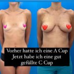 Victoria Jancke Instagram – Anzeige wegen Markierung
🇺🇸 I wanted fuller breasts but did not want implants. I wanted a natural look and feel.
Others doctors told me that I don’t have enough fat for a boob job with fat. But I did my research and found #DrKhouris @miamibreastcenter technique.
I wore his unique EVE device to prepare for the surgery. And with just 1 operation I had both nicely shaped full natural breasts (all from my own fat) and as a bonus a nicer waist line and butt! 🤩 It feels so nice to have natural fuller breast without putting dangerous implants into my body. I mean see yourself the incredible before and after result in my post 😍
Dr. Khouri is teaching the doctors in Regensburg how to do this. If you want nice breasts without implants you should contact the doctors in Regensburg: @dr.ebx @lprantl
🇩🇪 Ich wollte vollere Brüste, aber keine Implantate. Ich wollte ein natürliches Aussehen und Gefühl.
Andere Ärzte sagten mir, dass ich nicht genug Fett für eine Brustkorrektur mit Fett habe. Aber ich habe recherchiert und #DrKhouris @miami gefunden.
Ich trug sein spezielles EVE-Gerät, um mich auf die Operation vorzubereiten.
Und mit nur einer Operation hatte ich sowohl schön geformte, natürliche Brüste (aus meinem eigenen Fett) als auch eine schönere Taille und einen schöneren Po! 🤩 Es fühlt sich so schön an, eine natürlich vollere Brust zu haben, ohne gefährliche Implantate in meinen Körper einzusetzen.
Seht euch das unglaubliche Vorher-Nachher-Ergebnis in meinem Beitrag an 😍
Dr. Khouri bringt den Ärzten in Regensburg bei, wie das geht. Wenn Sie schöne Brüste ohne Implantate wünschen, sollten Sie sich an die Ärzte in Regensburg wenden: @dr.ebx @lprantl