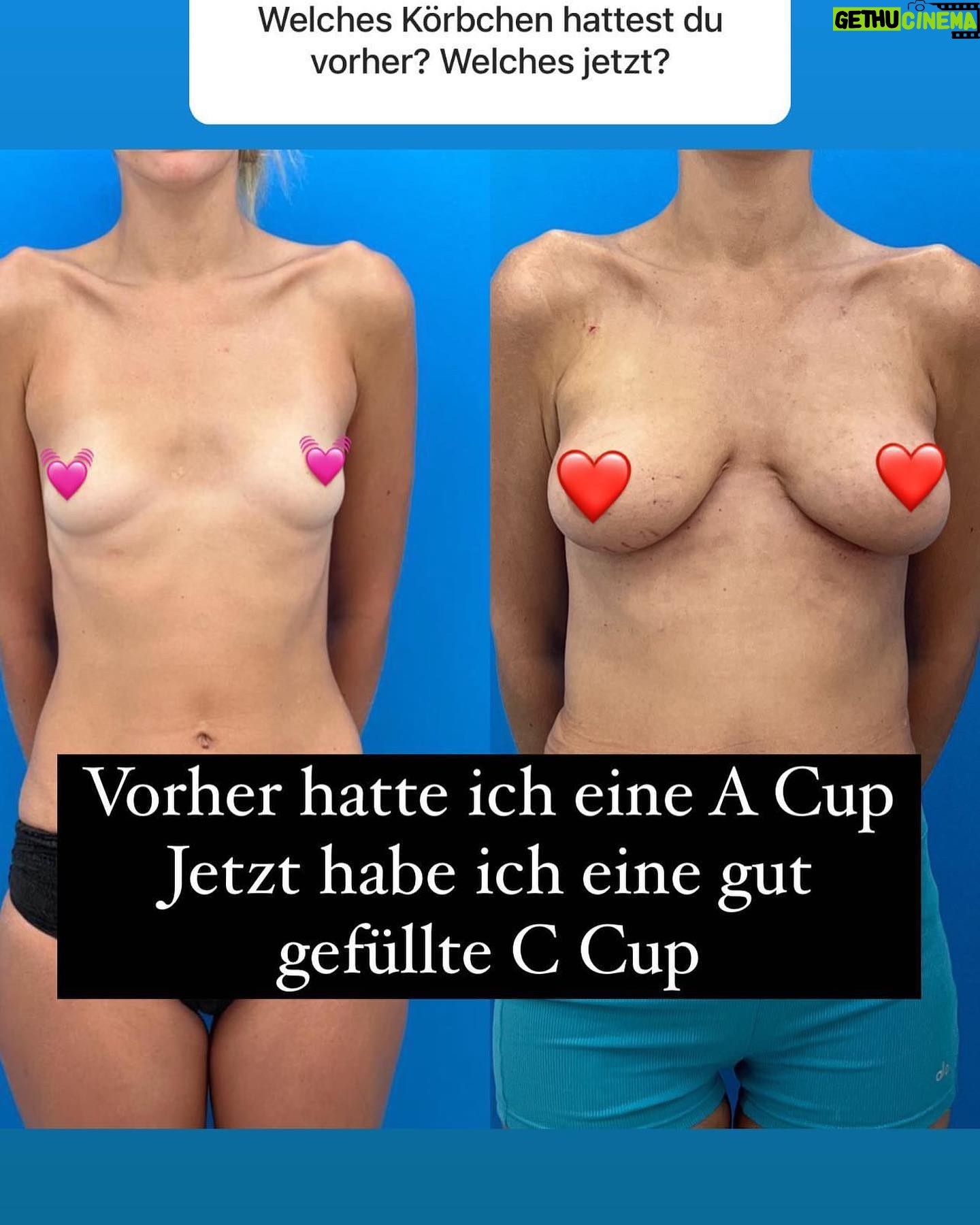 Victoria Jancke - 3 Likes - Anzeige wegen Markierung
🇺🇸 I wanted fuller breasts but did not want implants. I wanted a natural look and feel.
Others doctors told me that I don’t have enough fat for a boob job with fat. But I did my research and found #DrKhouris @miamibreastcenter technique.
I wore his unique EVE device to prepare for the surgery. And with just 1 operation I had both nicely shaped full natural breasts (all from my own fat) and as a bonus a nicer waist line and butt! 🤩 It feels so nice to have natural fuller breast without putting dangerous implants into my body. I mean see yourself the incredible before and after result in my post 😍
Dr. Khouri is teaching the doctors in Regensburg how to do this. If you want nice breasts without implants you should contact the doctors in Regensburg: @dr.ebx @lprantl
🇩🇪 Ich wollte vollere Brüste, aber keine Implantate. Ich wollte ein natürliches Aussehen und Gefühl.
Andere Ärzte sagten mir, dass ich nicht genug Fett für eine Brustkorrektur mit Fett habe. Aber ich habe recherchiert und #DrKhouris @miami gefunden.
Ich trug sein spezielles EVE-Gerät, um mich auf die Operation vorzubereiten.
Und mit nur einer Operation hatte ich sowohl schön geformte, natürliche Brüste (aus meinem eigenen Fett) als auch eine schönere Taille und einen schöneren Po! 🤩 Es fühlt sich so schön an, eine natürlich vollere Brust zu haben, ohne gefährliche Implantate in meinen Körper einzusetzen.
Seht euch das unglaubliche Vorher-Nachher-Ergebnis in meinem Beitrag an 😍
Dr. Khouri bringt den Ärzten in Regensburg bei, wie das geht. Wenn Sie schöne Brüste ohne Implantate wünschen, sollten Sie sich an die Ärzte in Regensburg wenden: @dr.ebx @lprantl