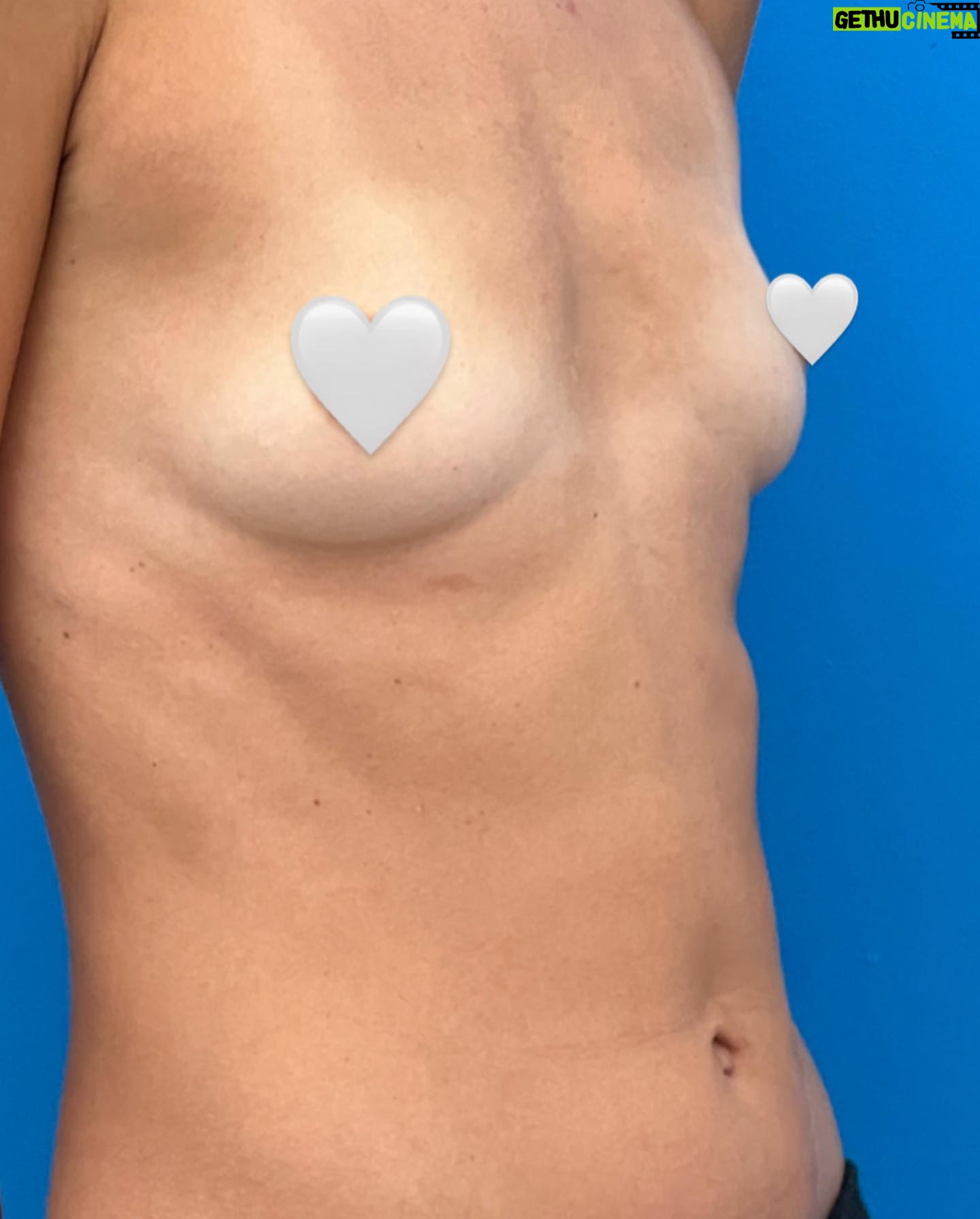 Victoria Jancke - 3 Likes - Anzeige wegen Markierung
🇺🇸 I wanted fuller breasts but did not want implants. I wanted a natural look and feel.
Others doctors told me that I don’t have enough fat for a boob job with fat. But I did my research and found #DrKhouris @miamibreastcenter technique.
I wore his unique EVE device to prepare for the surgery. And with just 1 operation I had both nicely shaped full natural breasts (all from my own fat) and as a bonus a nicer waist line and butt! 🤩 It feels so nice to have natural fuller breast without putting dangerous implants into my body. I mean see yourself the incredible before and after result in my post 😍
Dr. Khouri is teaching the doctors in Regensburg how to do this. If you want nice breasts without implants you should contact the doctors in Regensburg: @dr.ebx @lprantl
🇩🇪 Ich wollte vollere Brüste, aber keine Implantate. Ich wollte ein natürliches Aussehen und Gefühl.
Andere Ärzte sagten mir, dass ich nicht genug Fett für eine Brustkorrektur mit Fett habe. Aber ich habe recherchiert und #DrKhouris @miami gefunden.
Ich trug sein spezielles EVE-Gerät, um mich auf die Operation vorzubereiten.
Und mit nur einer Operation hatte ich sowohl schön geformte, natürliche Brüste (aus meinem eigenen Fett) als auch eine schönere Taille und einen schöneren Po! 🤩 Es fühlt sich so schön an, eine natürlich vollere Brust zu haben, ohne gefährliche Implantate in meinen Körper einzusetzen.
Seht euch das unglaubliche Vorher-Nachher-Ergebnis in meinem Beitrag an 😍
Dr. Khouri bringt den Ärzten in Regensburg bei, wie das geht. Wenn Sie schöne Brüste ohne Implantate wünschen, sollten Sie sich an die Ärzte in Regensburg wenden: @dr.ebx @lprantl
