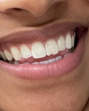 Zazie Beetz Instagram - GUYS. I JUST had this damn chip fixed in March! But she’s baccccckkkkkkkkk! Returned for her encore performance in my mouth! She said this is MY show, honey. Lorrrddd, if she can’t take a HINT?????