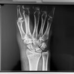 Zhavia Ward Instagram - Soo I fractured my wrist in 2 places and had to surgery but I’m healing now and still makin 🔥🔥🔥in the studio ✍🏼🍾🤓🤓🤓