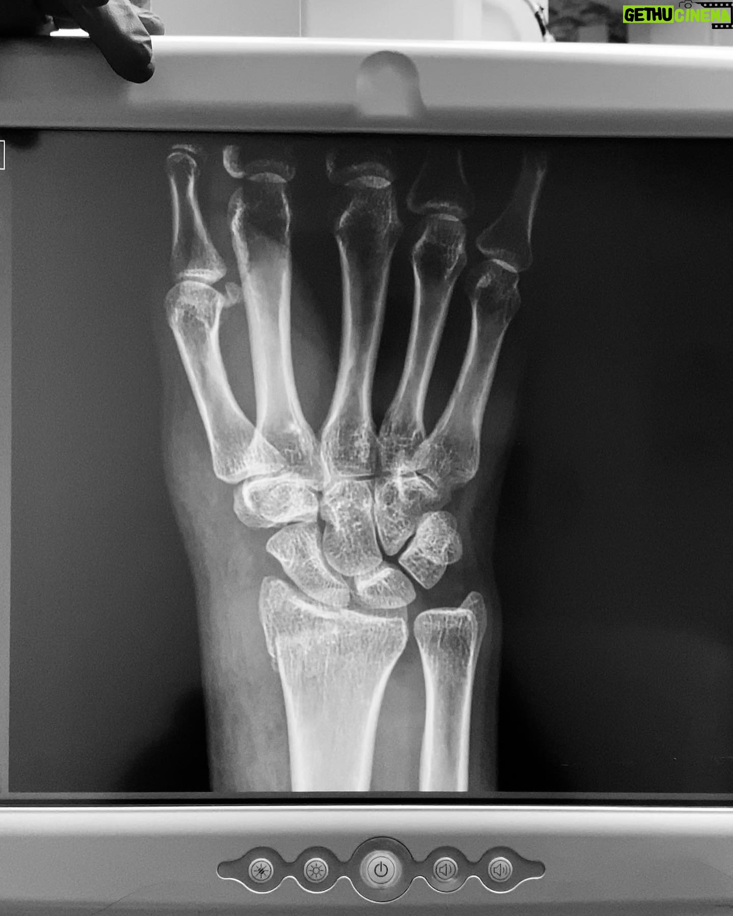Zhavia Ward Instagram - Soo I fractured my wrist in 2 places and had to surgery but Iβm healing now and still makin π₯π₯π₯in the studio βπΌπΎπ€π€π€