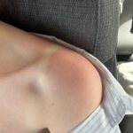 xooos Instagram – Sunburn🏖️