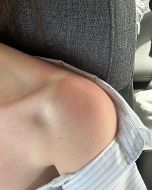xooos Instagram - Sunburn🏖️