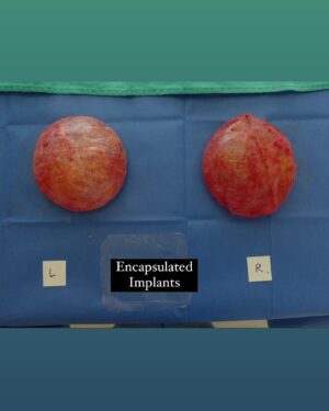 Adjua Styles Instagram - So…I did a THING last week! 

Let me start by saying that if you have had any work done specifically…breast implants, and all is well…kudos to you. Let me make it clear that by no means am I surgery-shaming anyone. If the changes make you happy and you are healthy, then that makes me even happier! However, I want to say that If you do and they’re raising any health concerns…make the necessary changes and/or just get rid of them altogether. Health first!

AS FOR ME, I had to get rid of my implants because of their toxicity. My body rejected them from the very start. It took 8 years and a laundry list of problems, but I finally had the courage to make the decision to remove them. 

I was beautiful before and I damn sure will be beautiful after. 

My advice: Before you make any semi-permanent/permanent changes, make sure you evaluate then reevaluate your consciousness (current state of mind). Also, make sure you ask a zillion questions. 10x out of 10you’re just wanting a superficial upgrade (like I did) without considering all that comes with an augmentation/plastic surgery procedure. 
Remember…you will change and/or evolve (hopefully) and grow at some point. That’s the natural course of life…Change! With growth comes different choices and wiser decisions overall and when that happens, you want to be happy with your choices!

Things change over time. Cigarettes weren’t denounced previously but now they are. There are many examples. My point is this: don’t wait until “they” decide to denounce implants to realize how unhealthy they can potentially become. Make sure your doctor explains the “cons” not just the “pros”. If you’re gonna go the plastic surgery route, then please, please listen to your body along with having the right testing done to ensure that your health is up to par along the way. 

Being in the health and wellness biz, it was imperative for me to find the root cause of the health issues I was facing. And…all roads lead to my implants. 

I hope I can inspire some. I’m gonna keep cutting out the bull 💩 in my life. Please believe it!!! Much love!!

#transparency #thegoodthebadandtheugly 
#healthiswealth