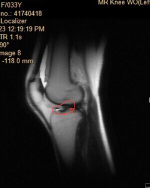 Alexandra Johnson Instagram - One year. ~120 days of physical therapy, 3 MRI’s, 1 ultrasound, 3 surgeon’s opinions, 2 orthopedic sports specialists, 5 amazing PT’s, 3 different braces, 4 new scars, countless unanswered questions, 0 days without pain.
Let’s see what the next 365 bring! 💪
