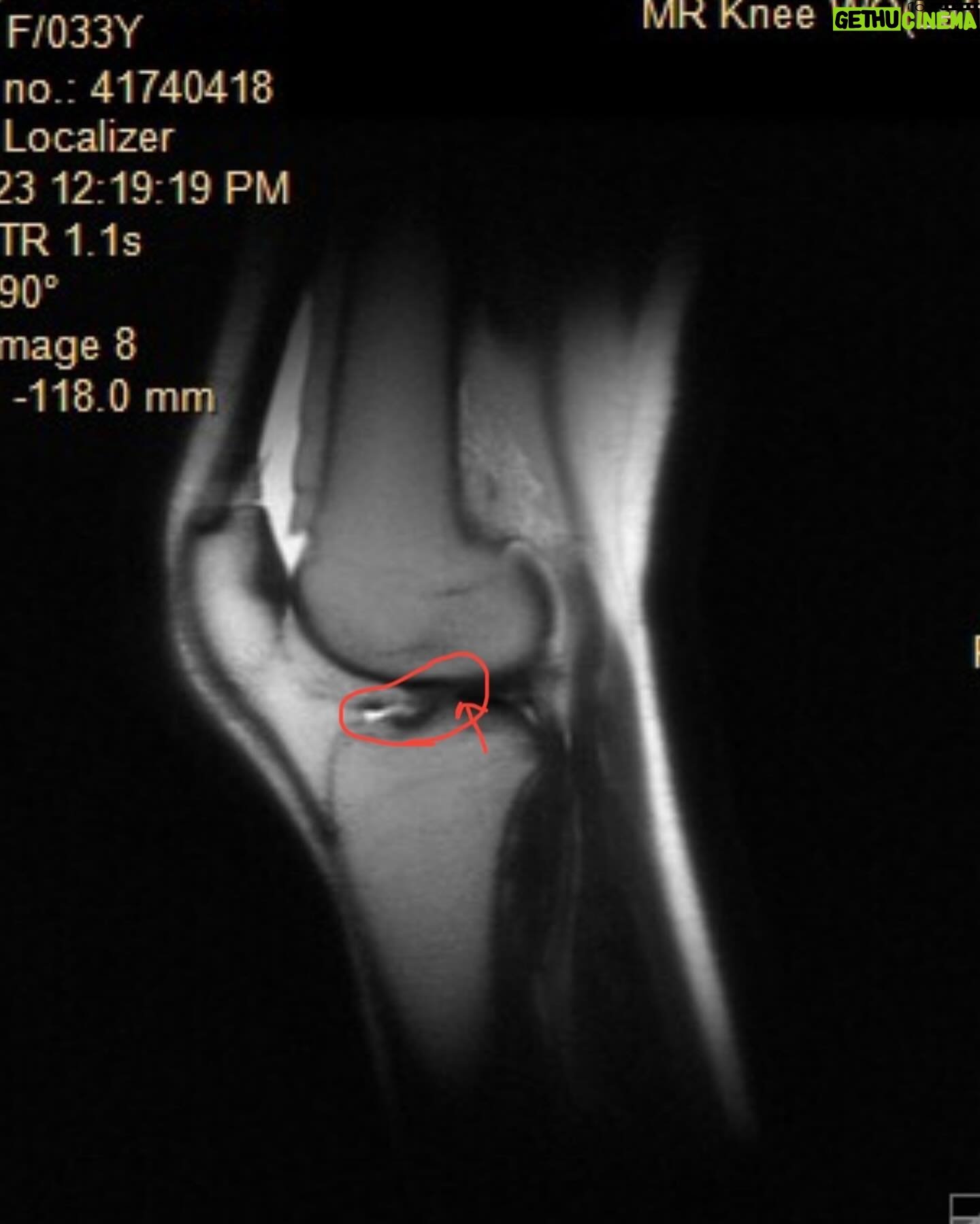 Alexandra Johnson - 4.8K Likes - One year. ~120 days of physical therapy, 3 MRI’s, 1 ultrasound, 3 surgeon’s opinions, 2 orthopedic sports specialists, 5 amazing PT’s, 3 different braces, 4 new scars, countless unanswered questions, 0 days without pain.
Let’s see what the next 365 bring! 💪