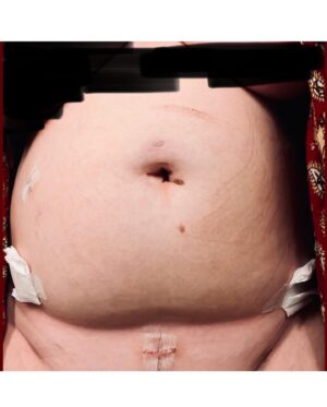 Amanda Fuller Instagram - A year ago today (well, yesterday now cause I accidentally deleted this whole damn thing and had to start all over again- 👋🏼 it’s me), I woke up from my first excision surgery for Endometriosis. They removed 27 endometrial masses (cysts etc) along with my appendix which was destroyed by it. My external scars have healed quite nicely (thank you docs), but the devastating truth is, my journey is only beginning again. I wish I could say I was cured. There is no cure. And after a few months of relief I had never even dreamed of (and having pain free, actually “normal”-ish periods for the first time in my life), my flare ups have come back with a vengeance. Constant and relentless. So, after waiting 25 long years for a proper diagnosis and any sort of treatment, I begin again. This is endometriosis. At least this time, I finally know what I am dealing with. For the most part. And I am sooooo not alone in this, which is why…

I thought what better day than today to honor this journey by announcing that I am starting a podcast. I know, 🙄. I certainly never thought I would be the one to join the podcast club, but… We need exposure, awareness, research, and allies to help the people born with uterus’ who suffer this monstrous disease get the help they so desperately deserve. We need an army. I have a responsibility to help build that army in any way I can. So, I present to you: @thatEndoPod - where I will share the unique and necessary stories of #endowarriors as well as interview experts in the field. We need each other. Episode one, where I will share my own story in full detail for the first time, will be released a month from today, June 27th 2023. Until then, be as well as you can be…and keep fighting.

With all my love-
a
 
#1. today 
#2. a year ago tomorrow
#3. a year ago tomorrow 
#4. a year ago today
#5. art by yours truly, from the notes app, cause I’m fancy like that